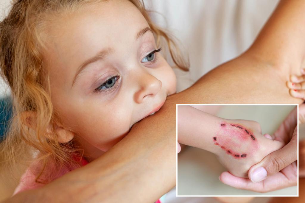 Imagem de destaque para o post: My toddler was bitten at daycare – should I confront the bitten’s parents to apologize?